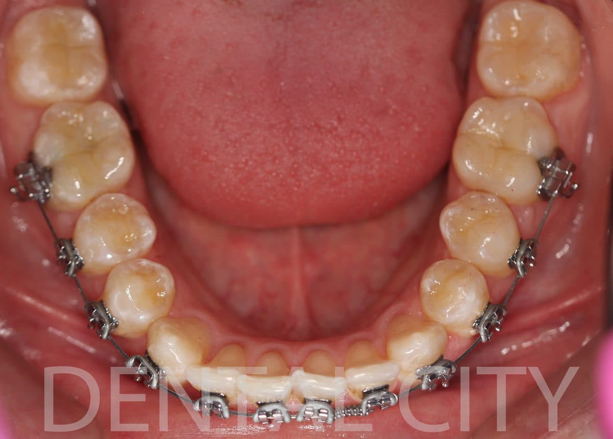 Tooth-colored composite restorations replacing amalgam