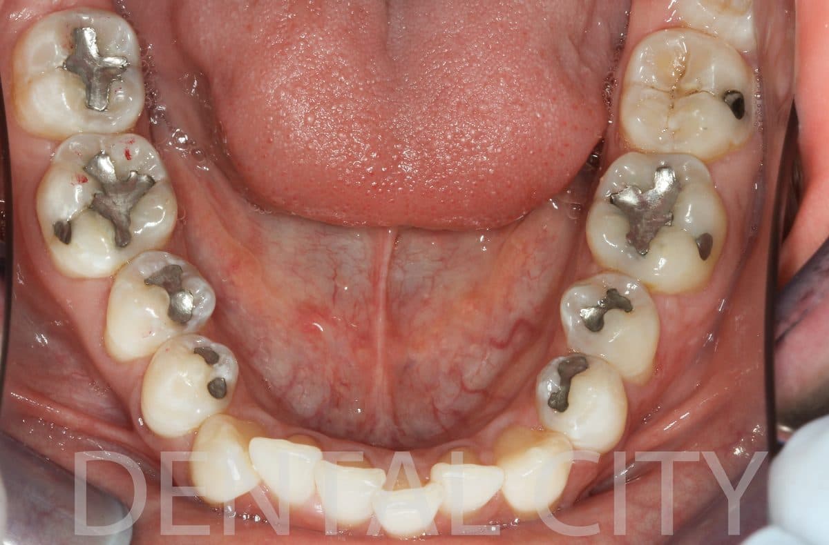 Old silver amalgam fillings before cosmetic restoration