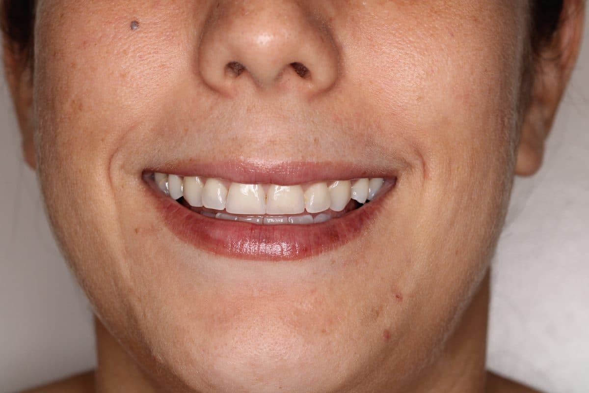 Proportional gumline after gummy smile correction