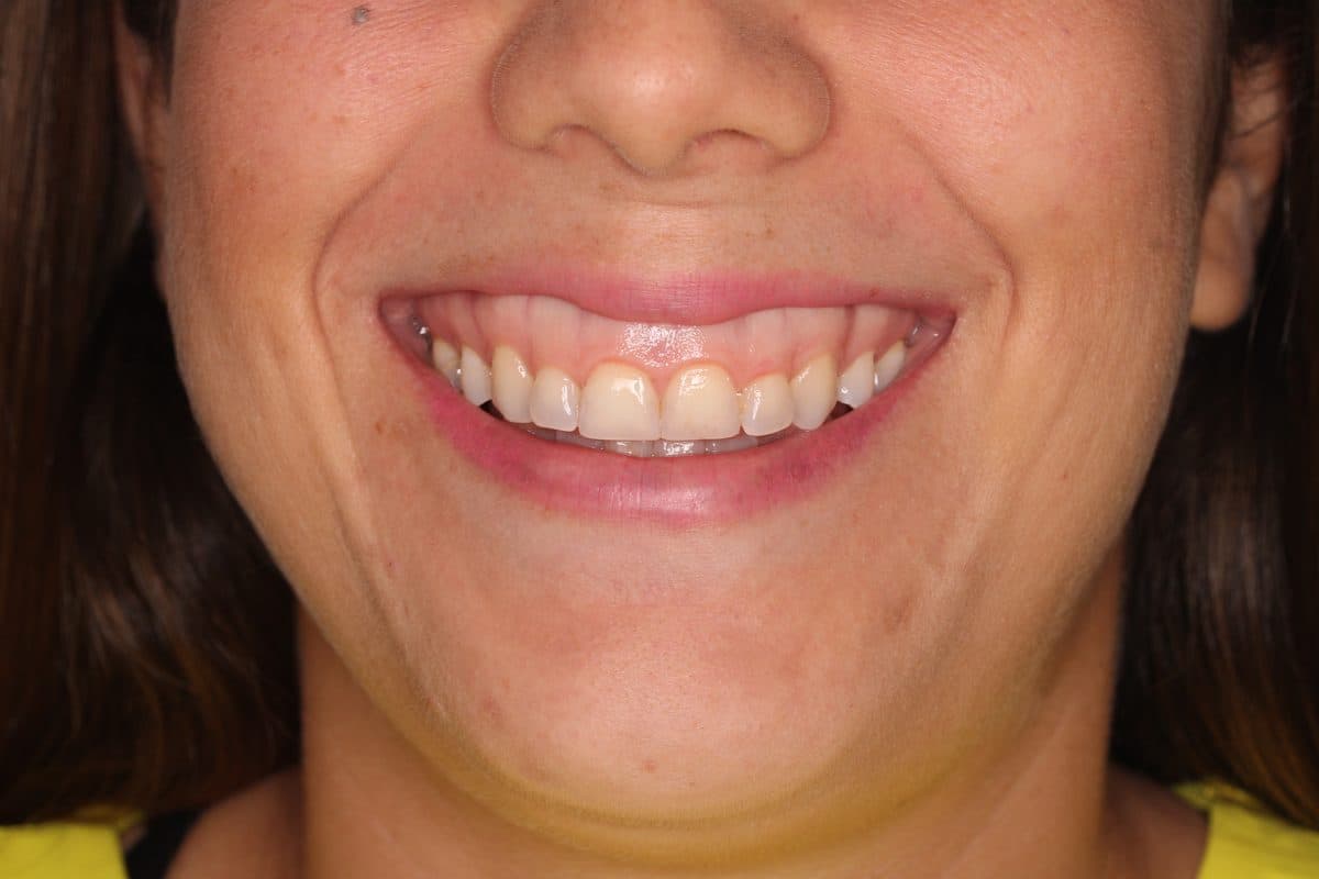 Excessive gum display when smiling before correction