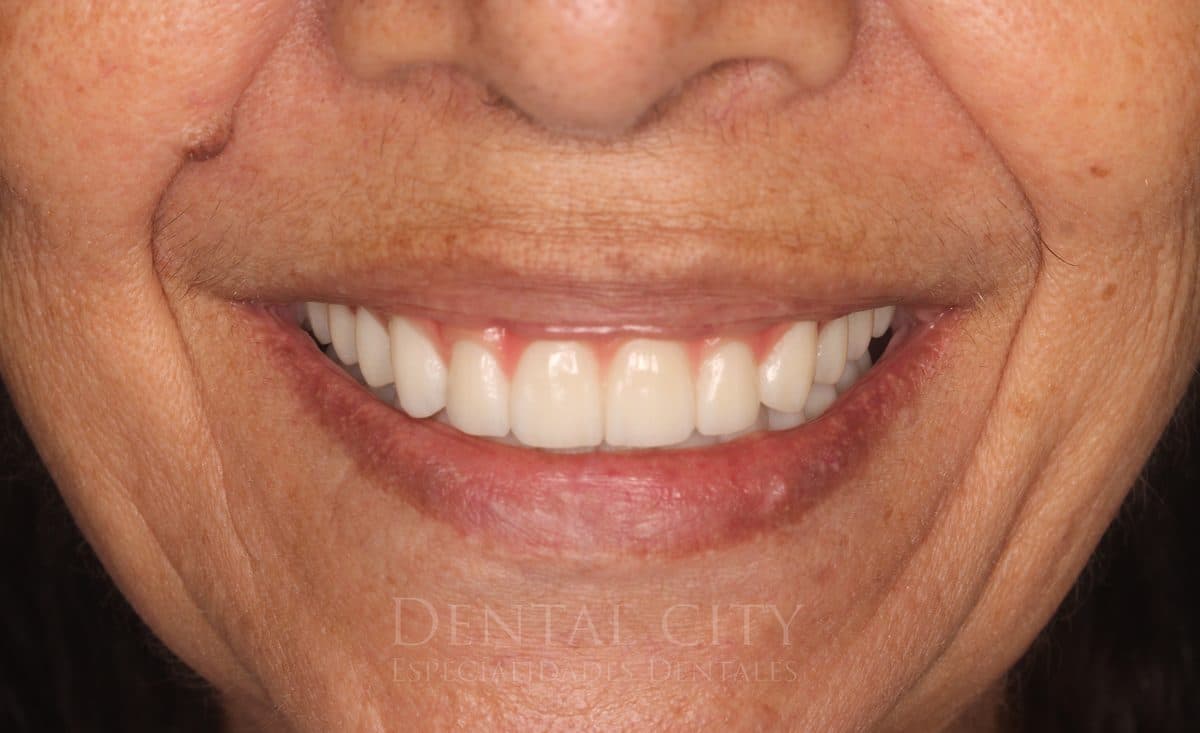 Complete restored smile after implant-supported prosthetics