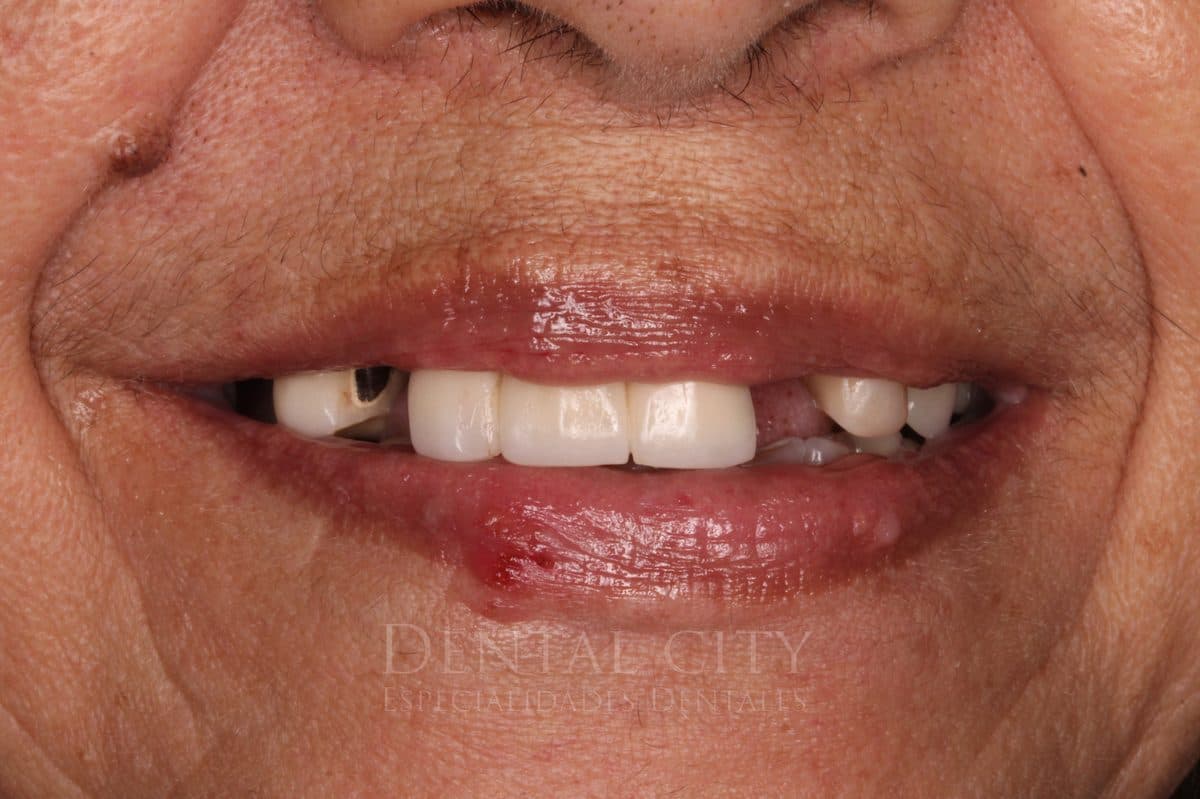 Patient with missing and damaged teeth before implant prosthetics
