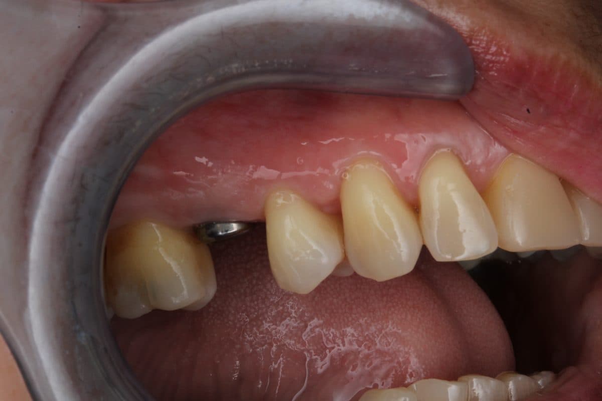Missing upper teeth with implant abutment visible