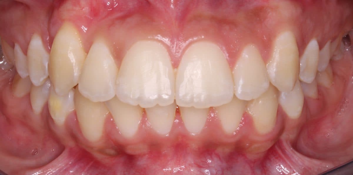 Aligned straightened teeth after orthodontic treatment