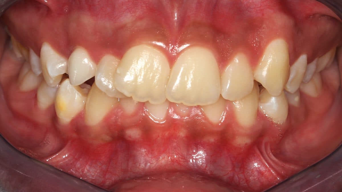Crowded misaligned teeth before orthodontic treatment