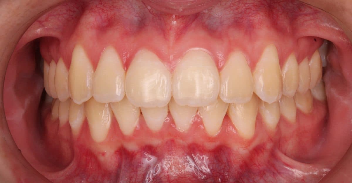 Well-aligned dental arch after orthodontic treatment