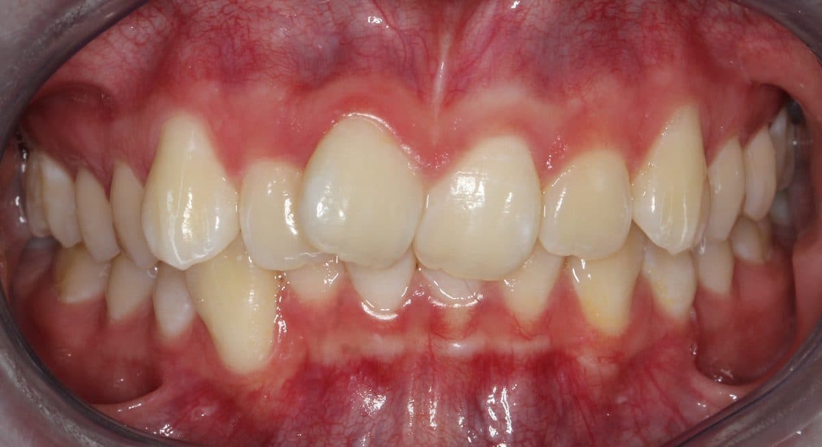 Crowded overlapping teeth with crossbite before treatment