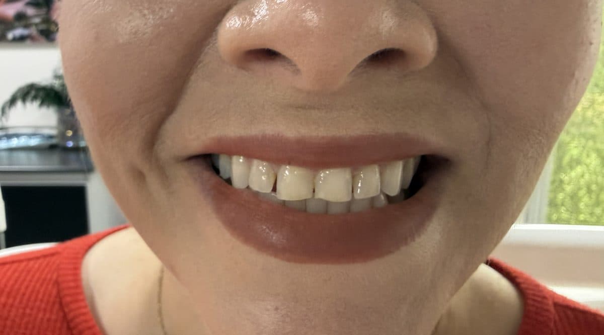 Symmetrical smile after facial harmonization treatment