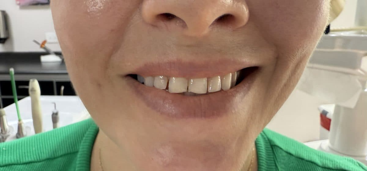 Asymmetric smile before facial harmonization