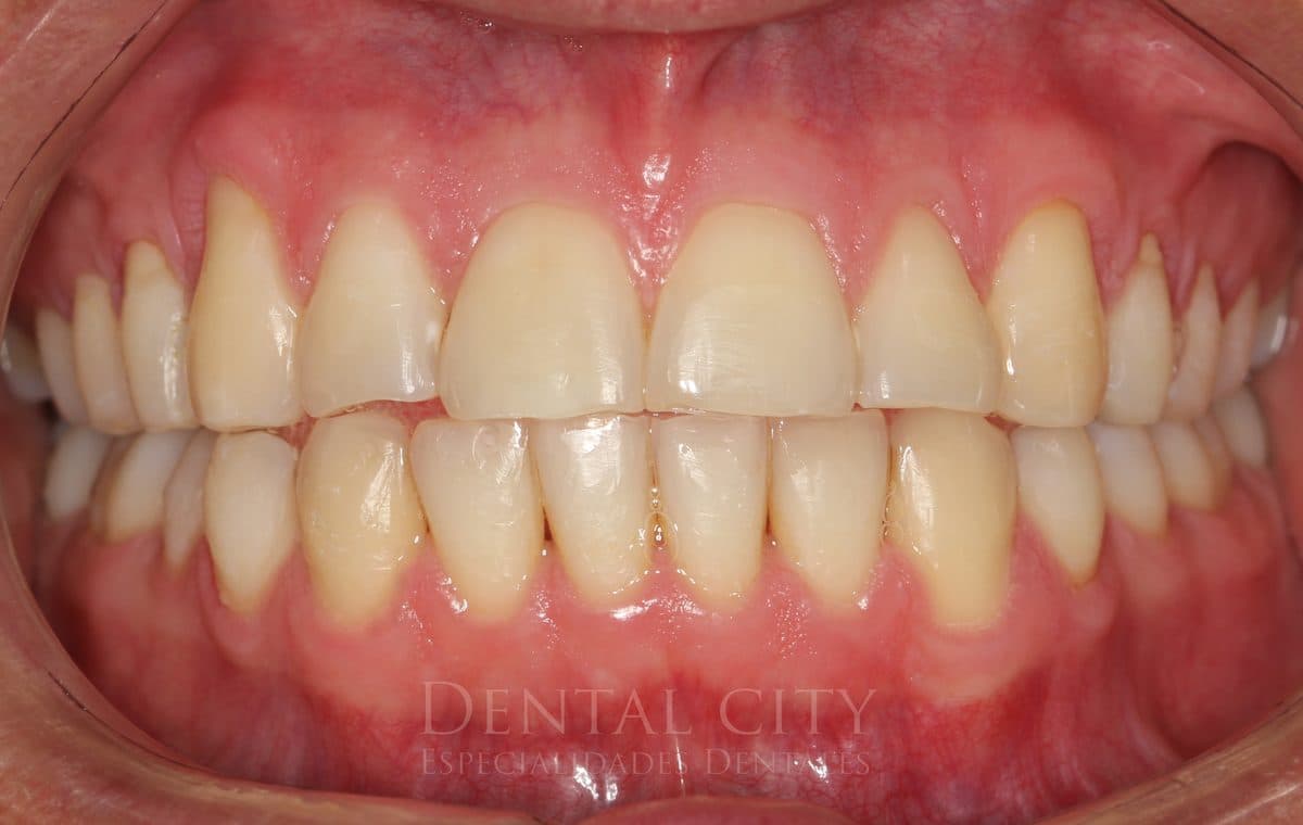 Natural tooth color before professional whitening