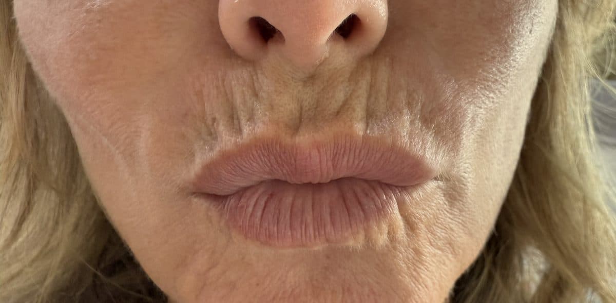Perioral wrinkles before treatment