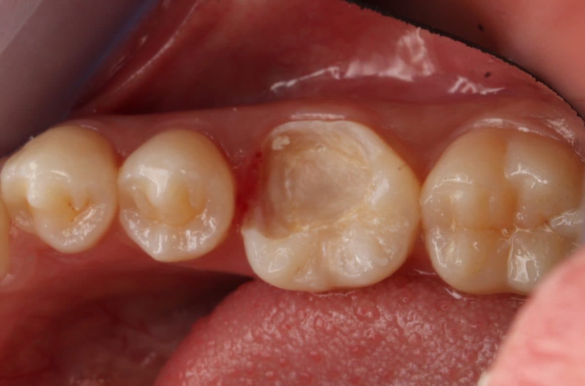 Worn dental restoration