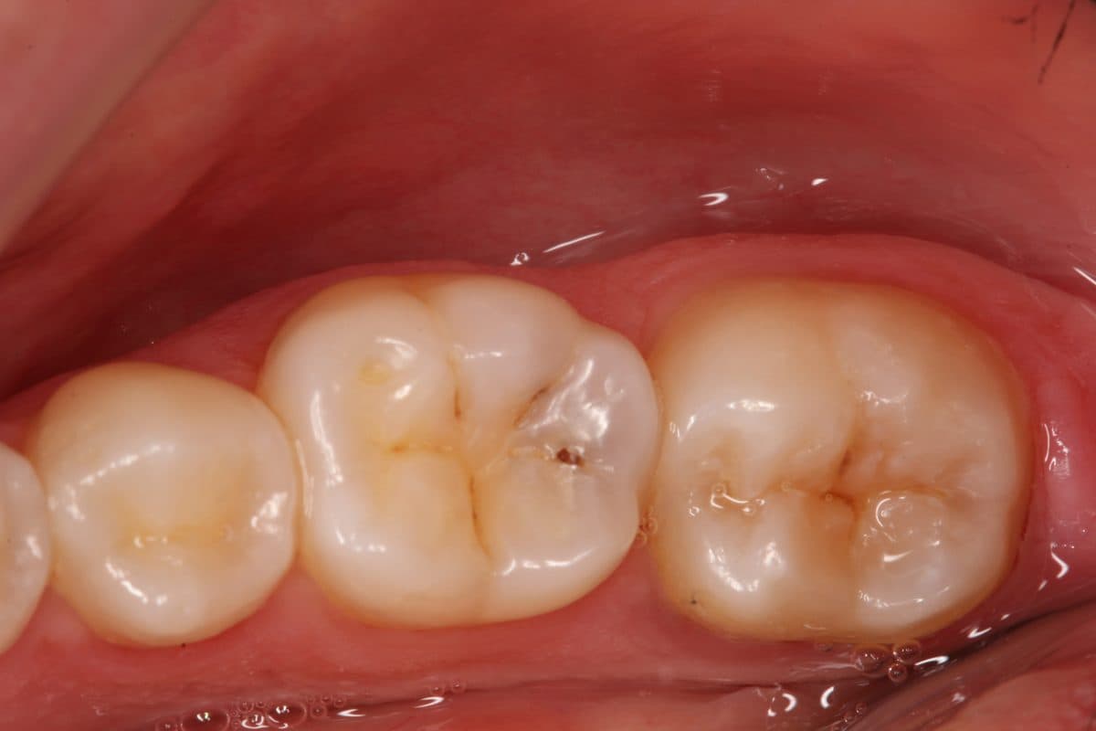 Natural-looking composite restorations