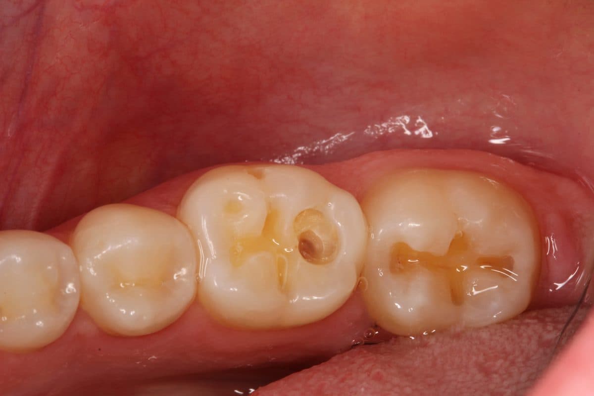 Cavities and deteriorated fillings