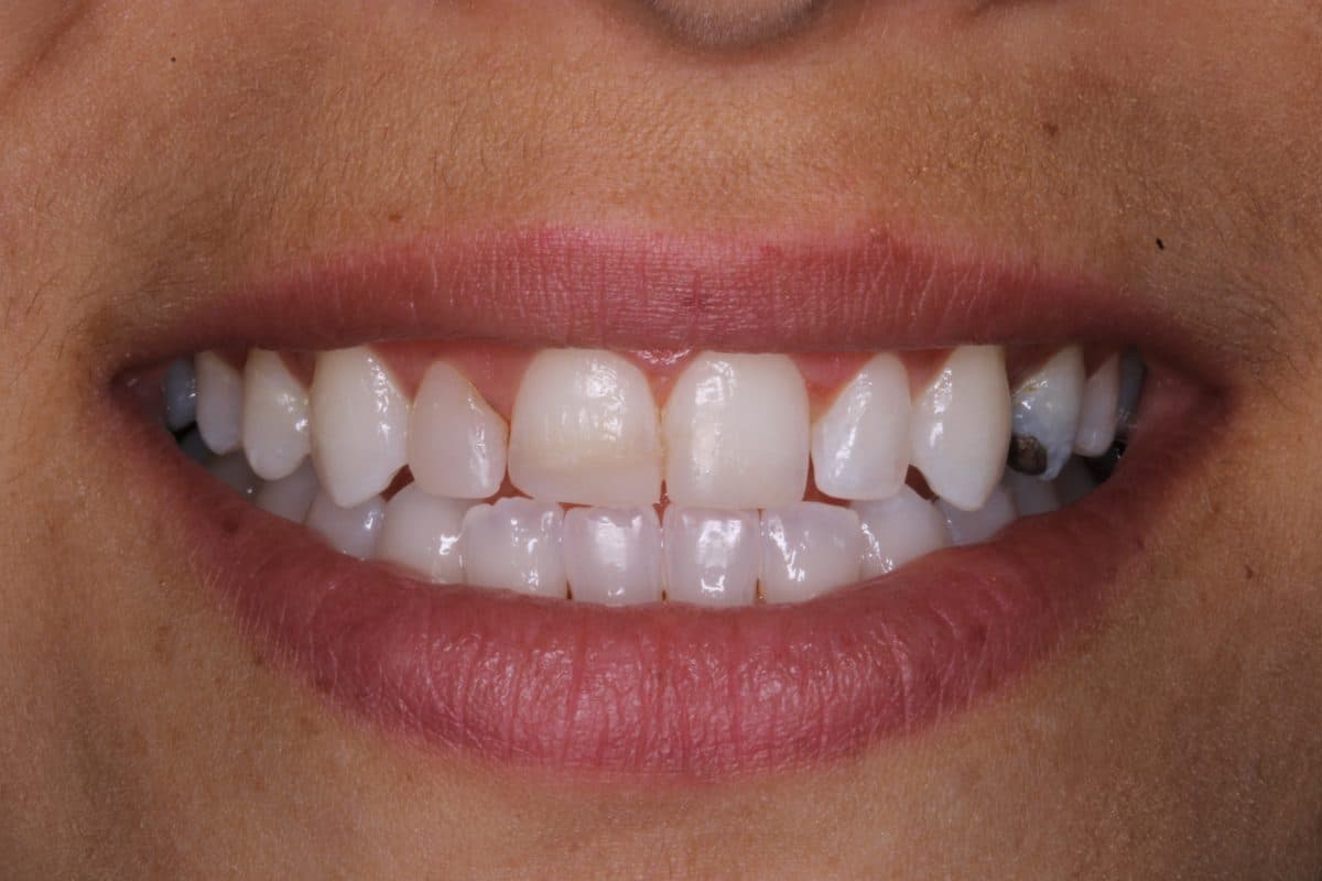 Irregular teeth with spacing before treatment