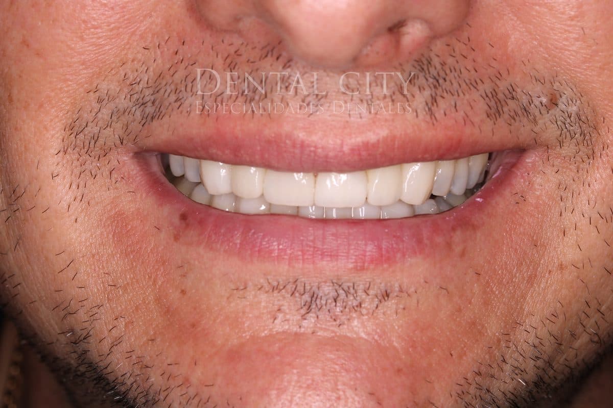 Stunning uniform smile after full makeover