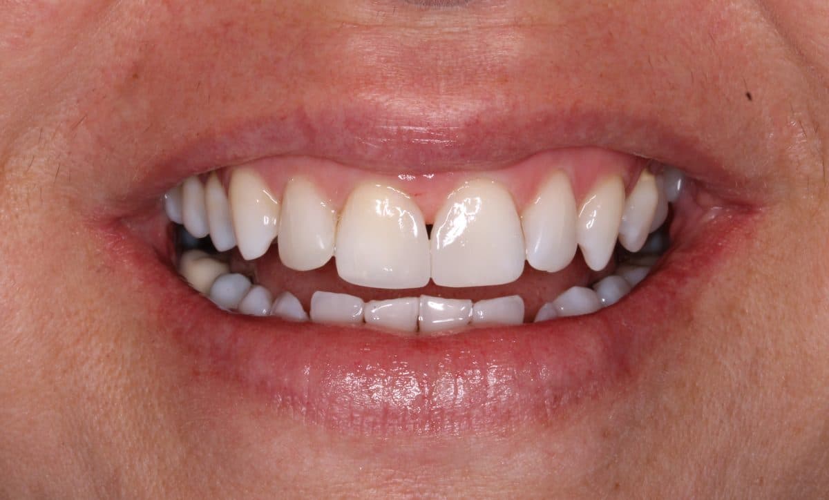Improved smile after veneer placement