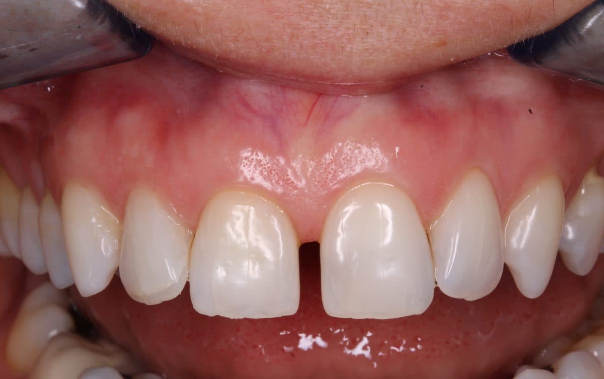 Clinical view showing gap between teeth