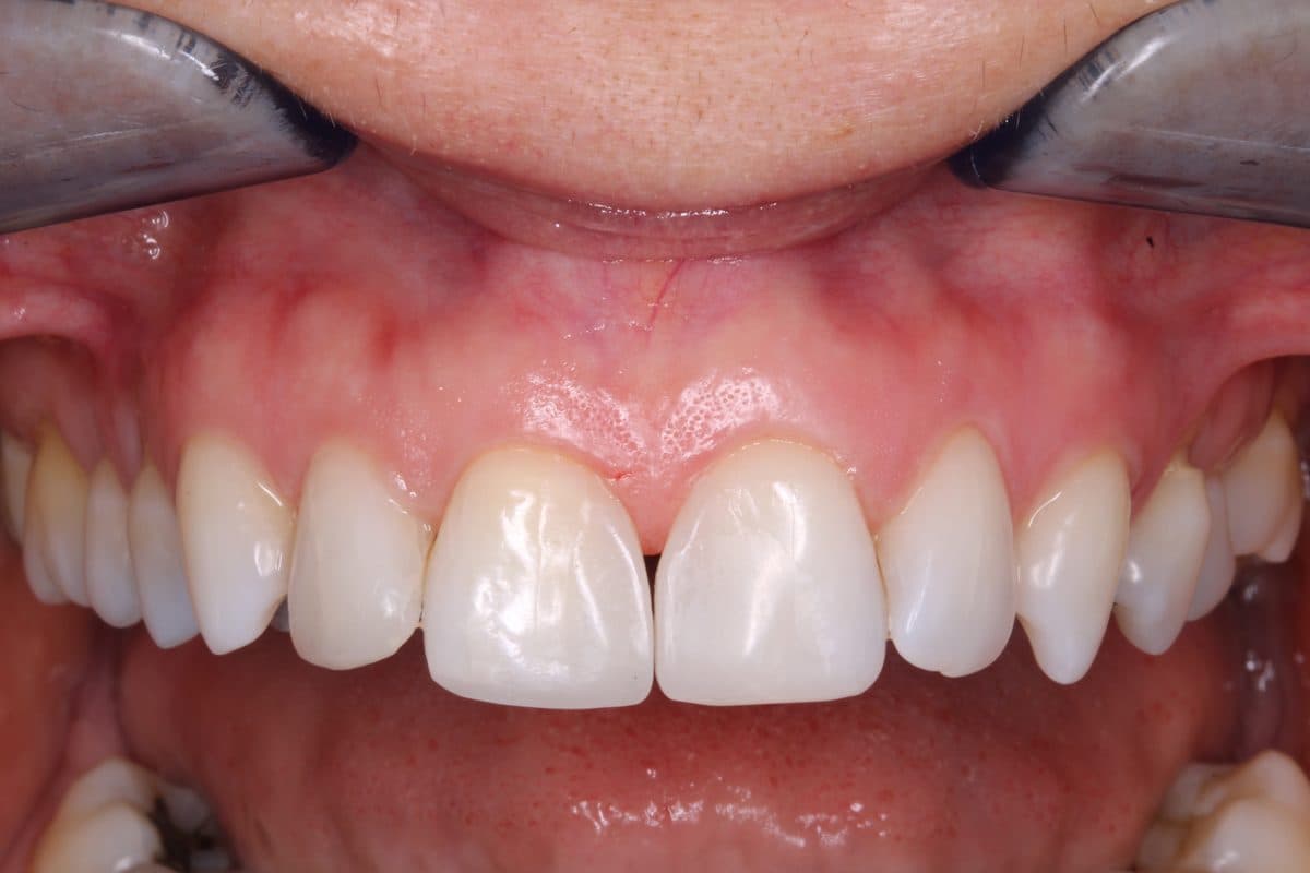 Clinical view after veneer placement with gap closed